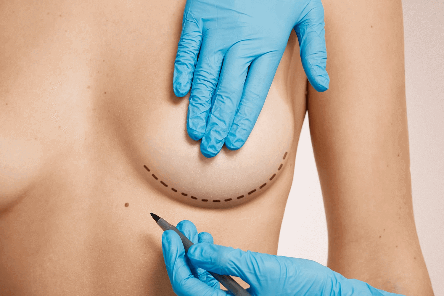Implantes mamários: colocar à frente ou atrás do músculo?